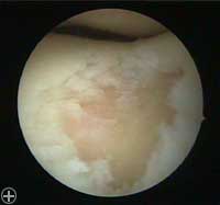 Abb. 3 Dieses Arthroskopie-Standbild zeigt einen zirka 1,5 cm im Durchmesser großen Knorpeldefekt im Gleitlager für die Kniescheibe.